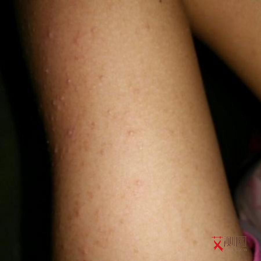 艾滋病身体长红点图片大全图解图