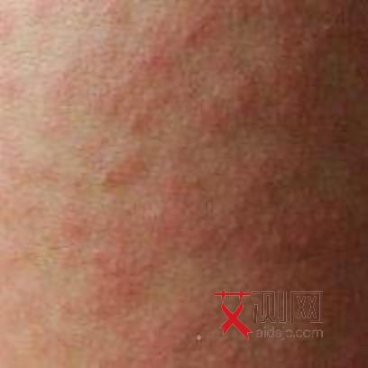 艾滋病症状特点男性多见吗会传染吗