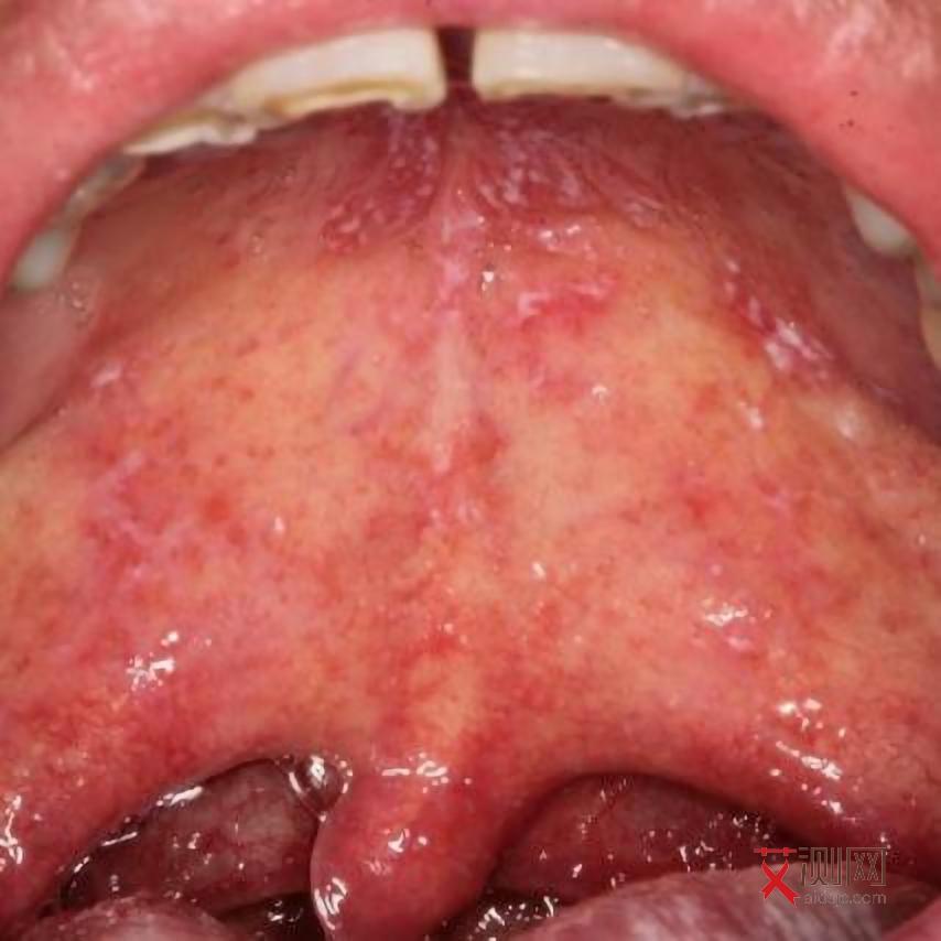 男艾滋病的症状是什么样子图片