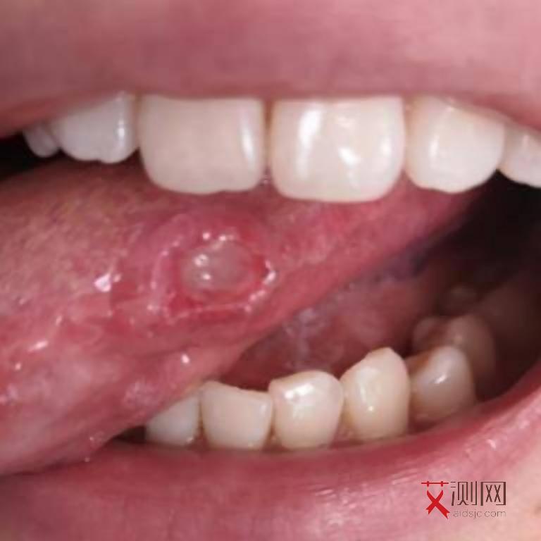 艾滋病的症状和体征有哪些