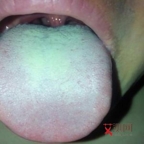 艾滋多久有明显症状出现