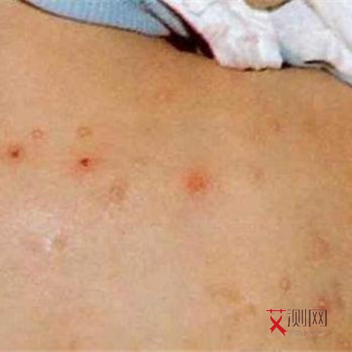 艾滋痒下面有什么症状图片大全图解