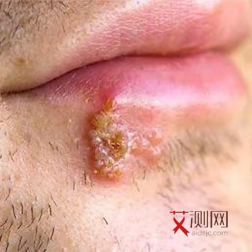 艾滋病口腔溃疡会好吗？