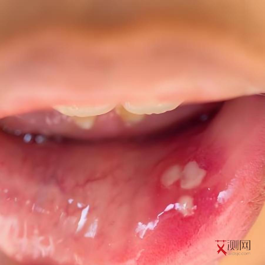 艾滋病多长时间才会发现症状