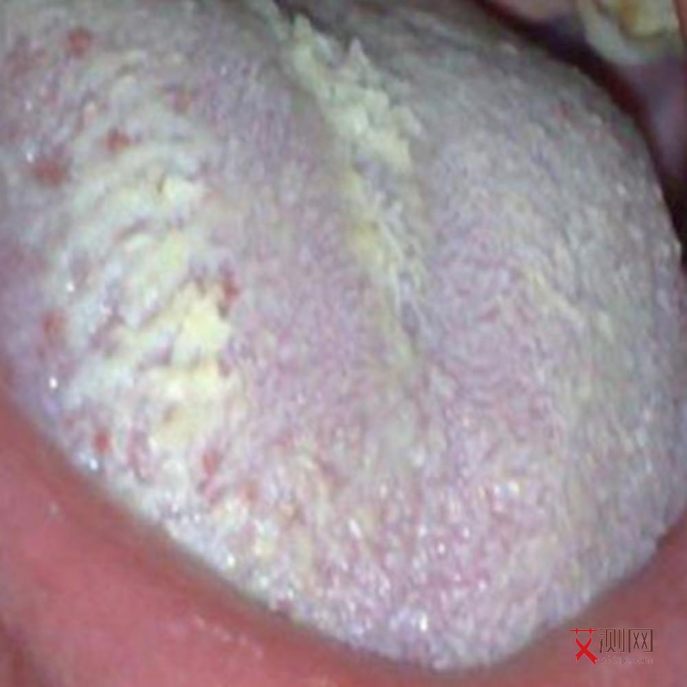 艾滋病有啥反应吗