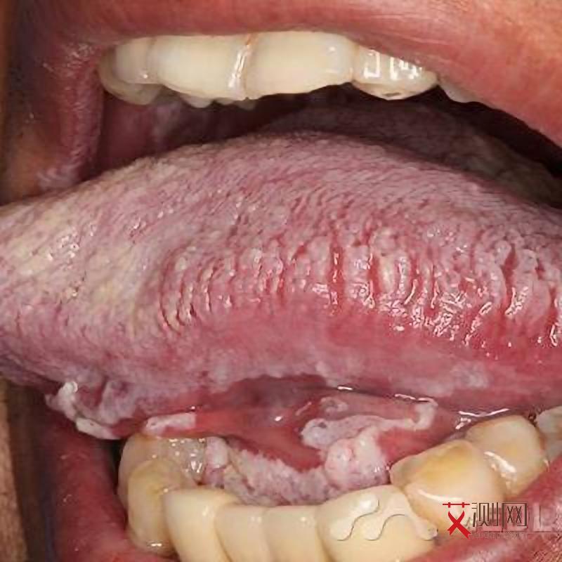 艾滋病会持续多久有症状呢图片