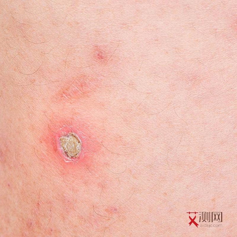 艾滋病积极治疗还会死亡吗