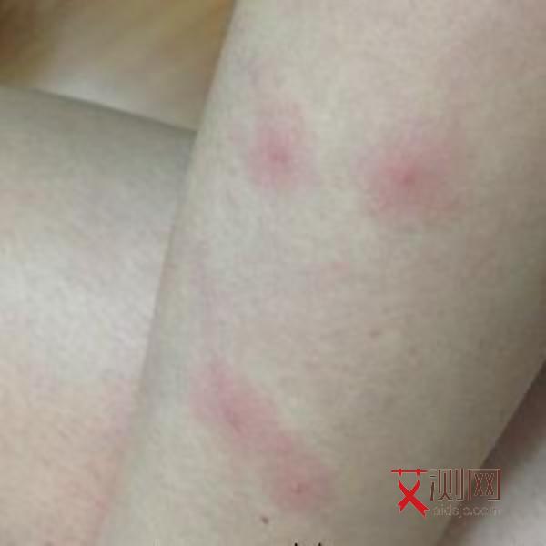 艾滋病症状特点男性多见吗会传染吗