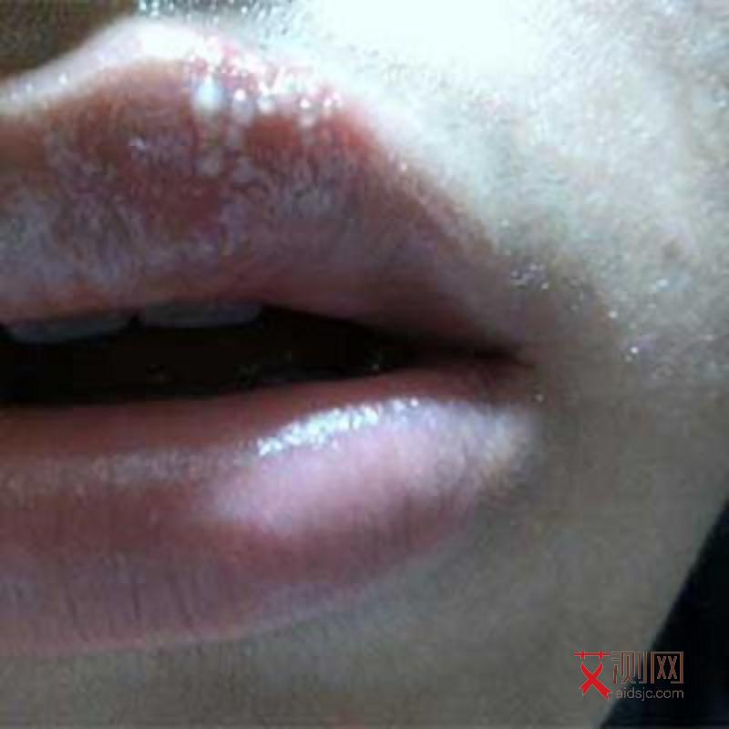 艾滋病初期皮肤小红点照片