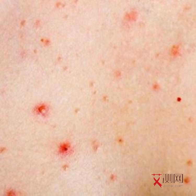 艾滋病唾液传不传染给家人