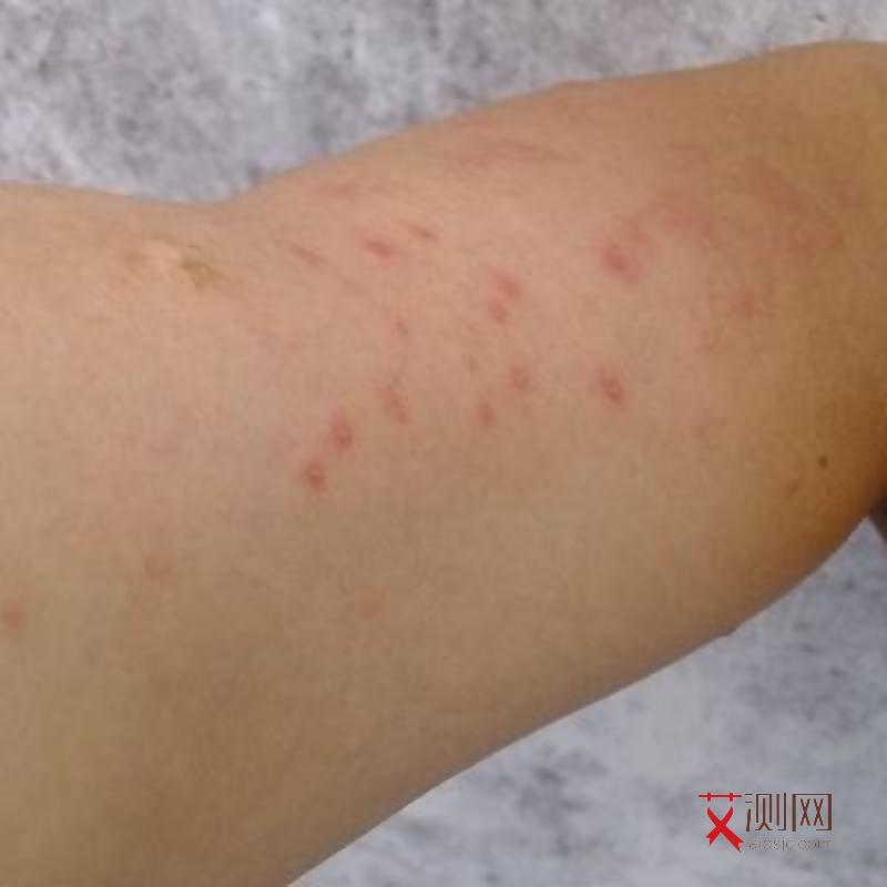 艾滋病征兆多久出现症状表现呢女性