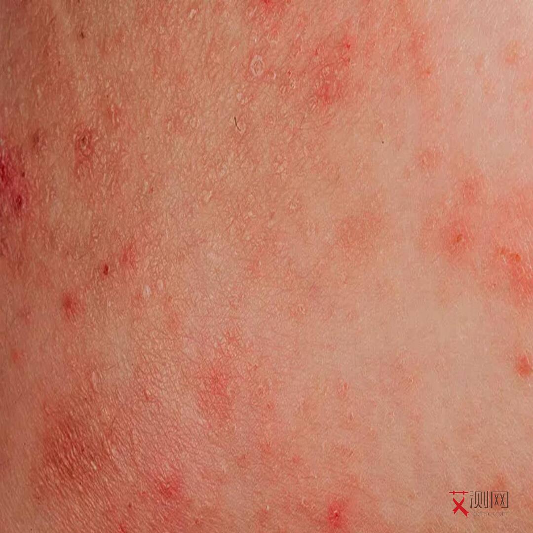 艾滋病症状及治疗方案最新研究