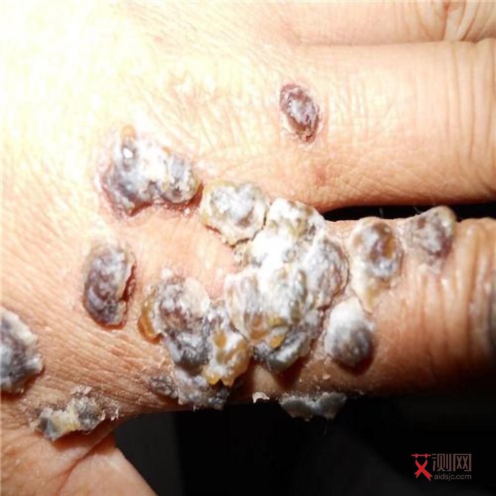 男性艾滋病患者下面有什么症状图片