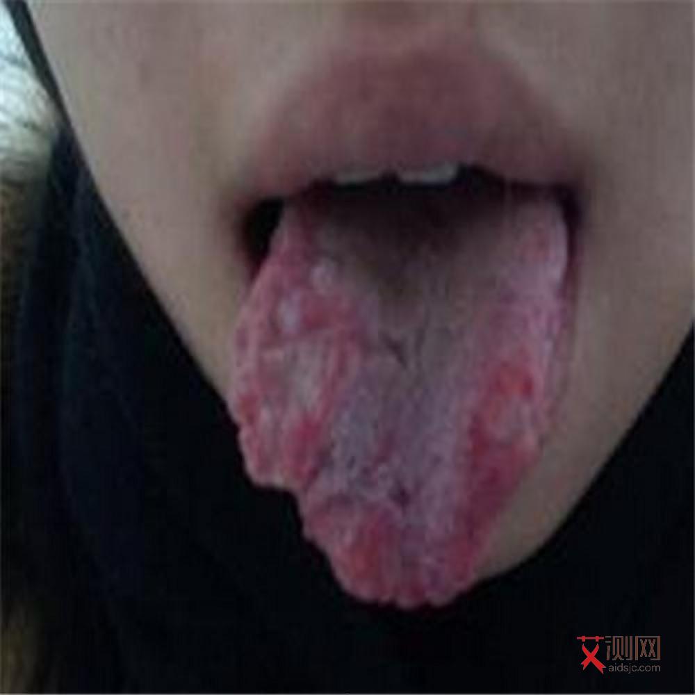 艾滋病人唾液含有病毒吗