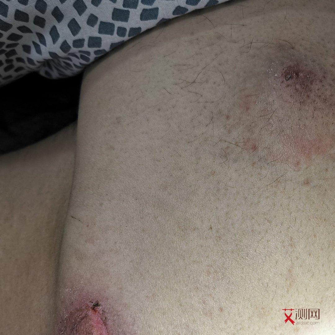 高危后多久可以试纸检测艾滋病