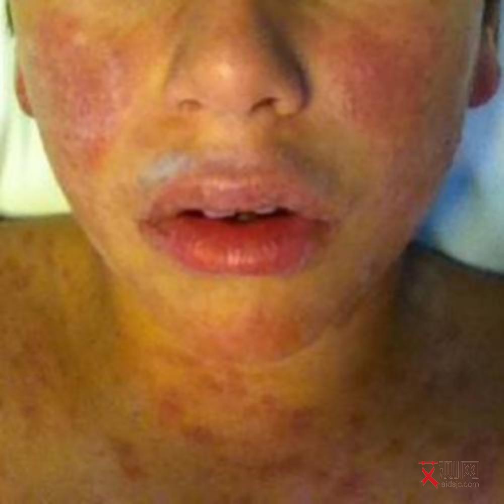 艾滋病初期症状出现在什么时候出现