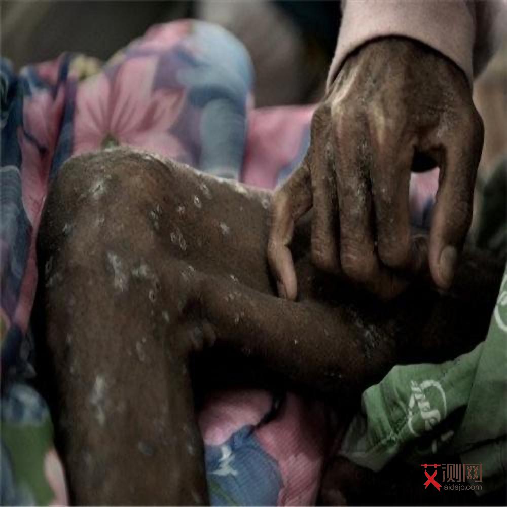 女艾滋病症状图片大全集高清