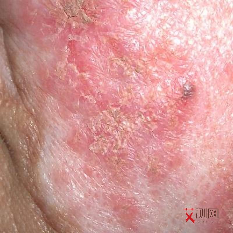 牙龈出血是不是艾滋病初期症状呢怎么治疗