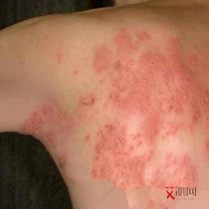 阴性是艾滋病还是阳性是艾滋病