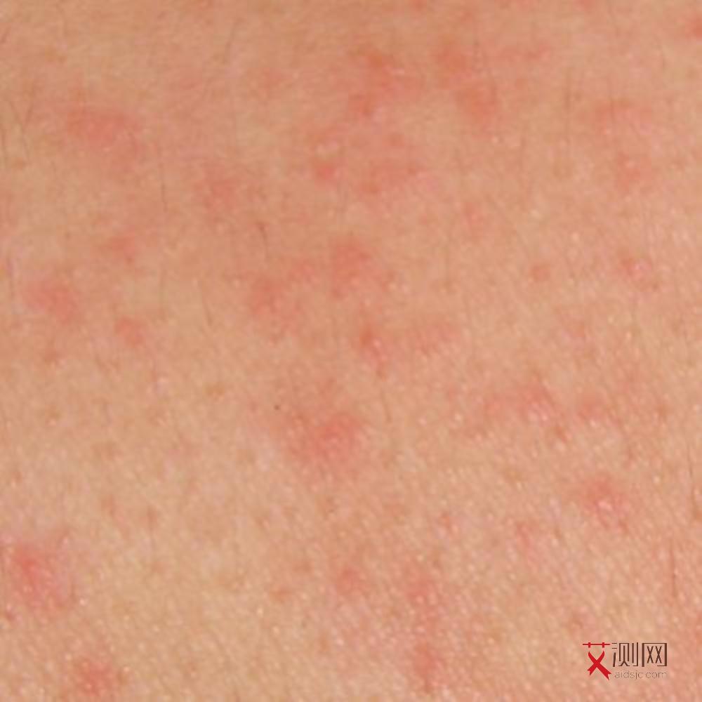 一般艾滋病多久有症状啊女性