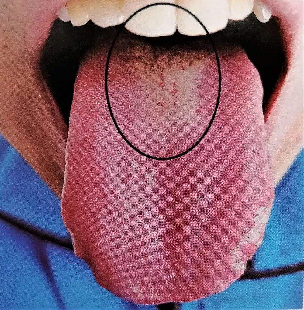 艾滋病舌苔发白症状
