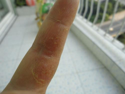 艾滋病高危行为后多久出现症状