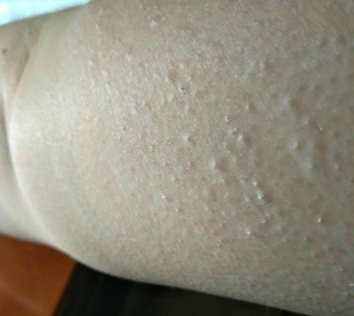 艾滋病荨麻疹症状