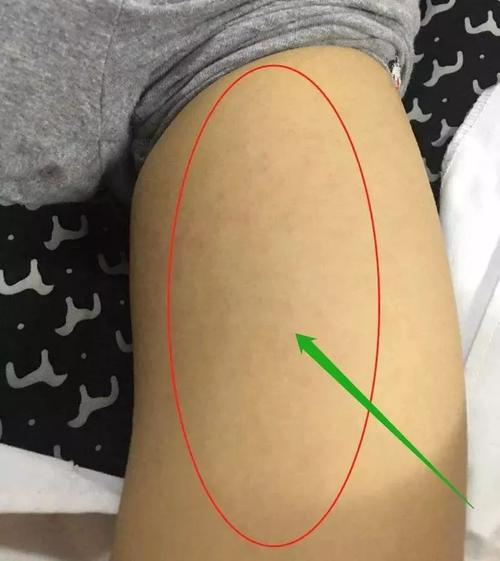 艾滋病荨麻疹吃药能好吗