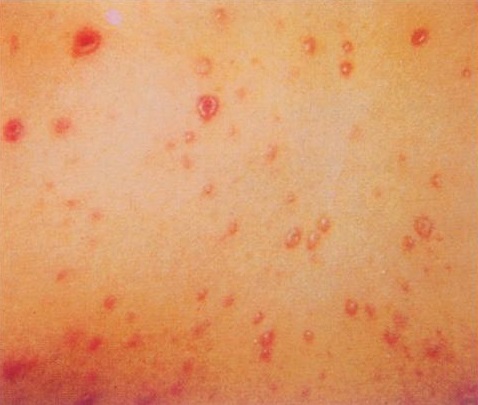 艾滋病前期的色素斑图片