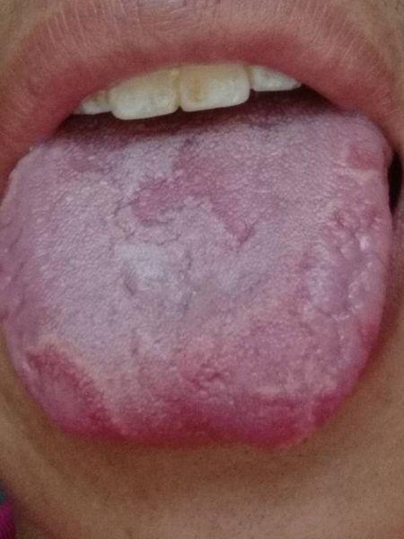 舌头灼烧感是艾滋病吗：艾滋病没有舌头灼烧感的表现