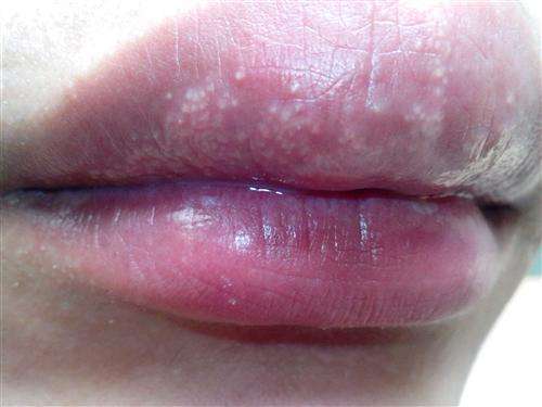 嘴唇出现白色颗粒主要是由嘴唇的皮脂腺异位引起的,一般来说不需要