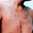 艾滋病皮疹图片：皮疹硬化泛黑