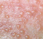 皮肤性病变是艾滋病潜伏期的主要症状之一。