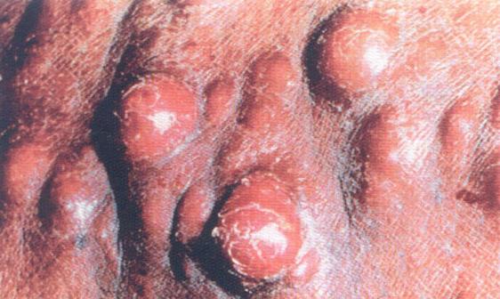 艾滋病皮肤图片：卡波西肉瘤。