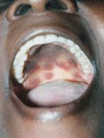 艾滋病口腔溃疡：上颚部位呈损伤较严重