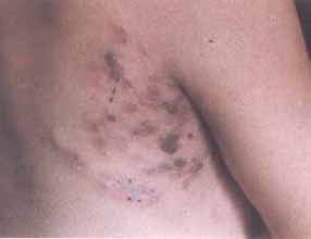 艾滋病皮肤初期症状：红褐色皮疹