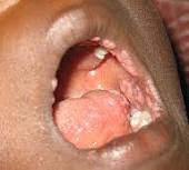 艾滋病口腔溃疡图片：嘴巴内部两侧