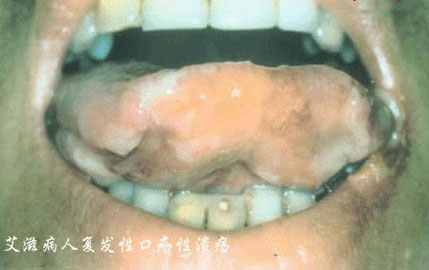艾洋病窗口期舌苔是没有显著变化的