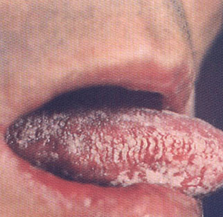 艾滋病十种自我检查：口腔念珠菌感染。