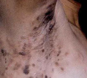 艾滋病症状图片：皮肤病变严重且泛黑硬化