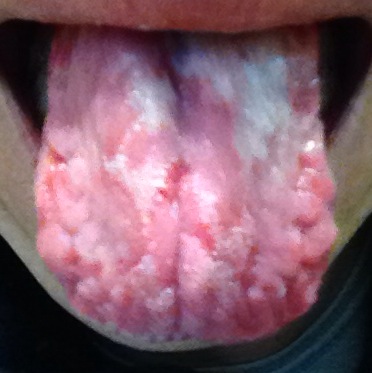 其它一些疾病也有可能会造成舌苔发白的症状,如艾滋病