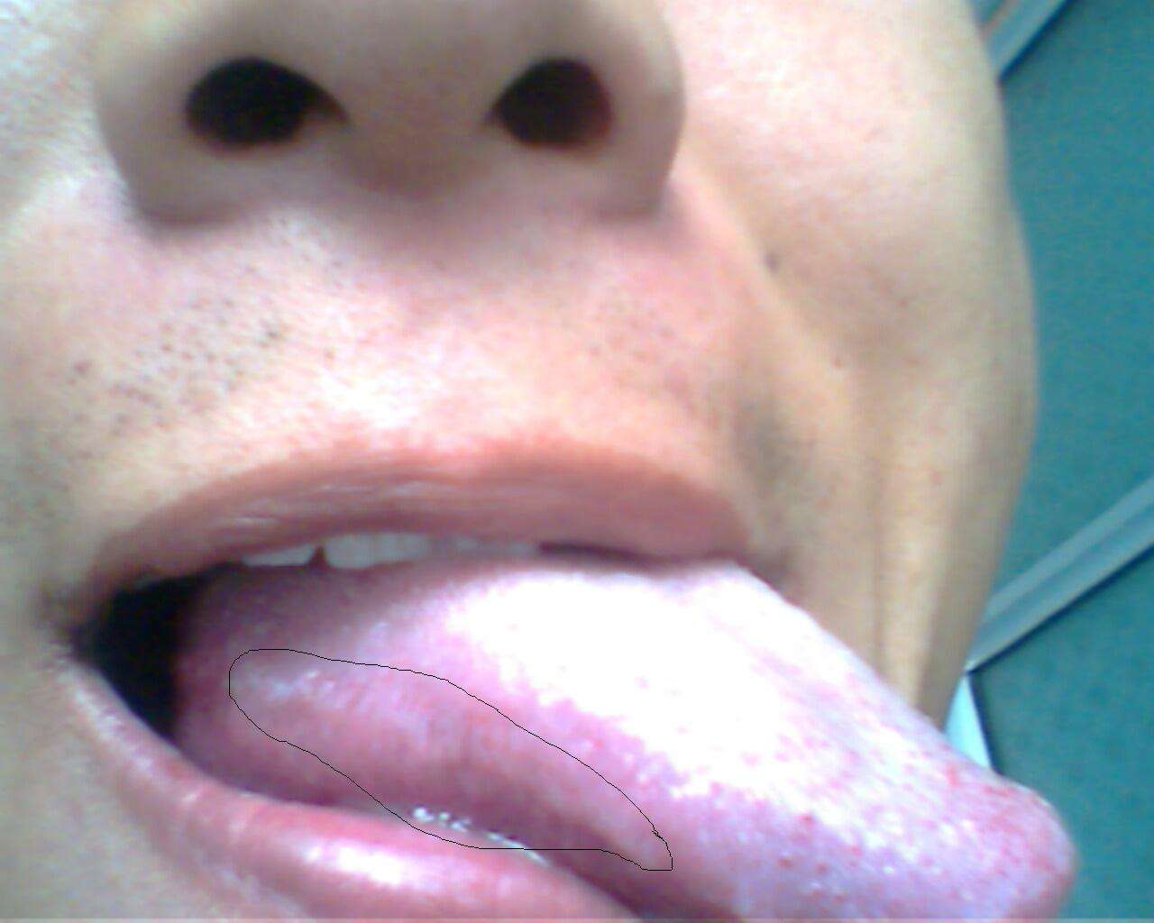 艾滋病舌头底部图片图片