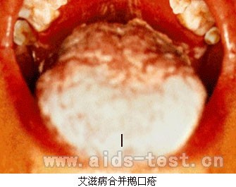 鵝口瘡是由於白色念珠菌感染感染口腔而引起的.這是一種真