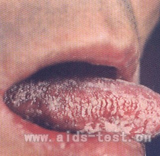 艾滋病口腔毛状白斑症状