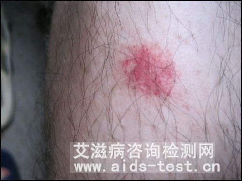 艾滋病痘痘一般长在哪图片