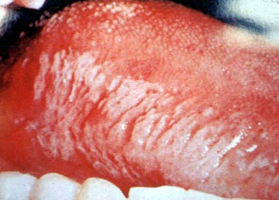 艾滋病初期症状中的毛状白斑
