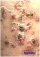 梅毒皮肤症状