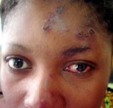 艾滋病初期图片