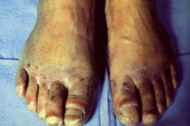 艾滋病皮疹，病人脚部